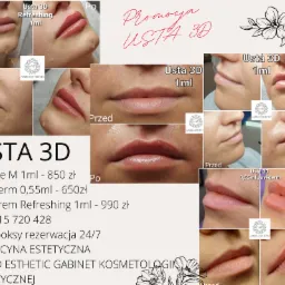 Kolaż zdjęć ust przed i po zabiegu powiększania, prezentujący efekt 'Usta 3D' z użyciem preparatów Stylage M, Juvederm i Juvedrem Refreshing, wykonany w gabinecie AMRO Esthetic.