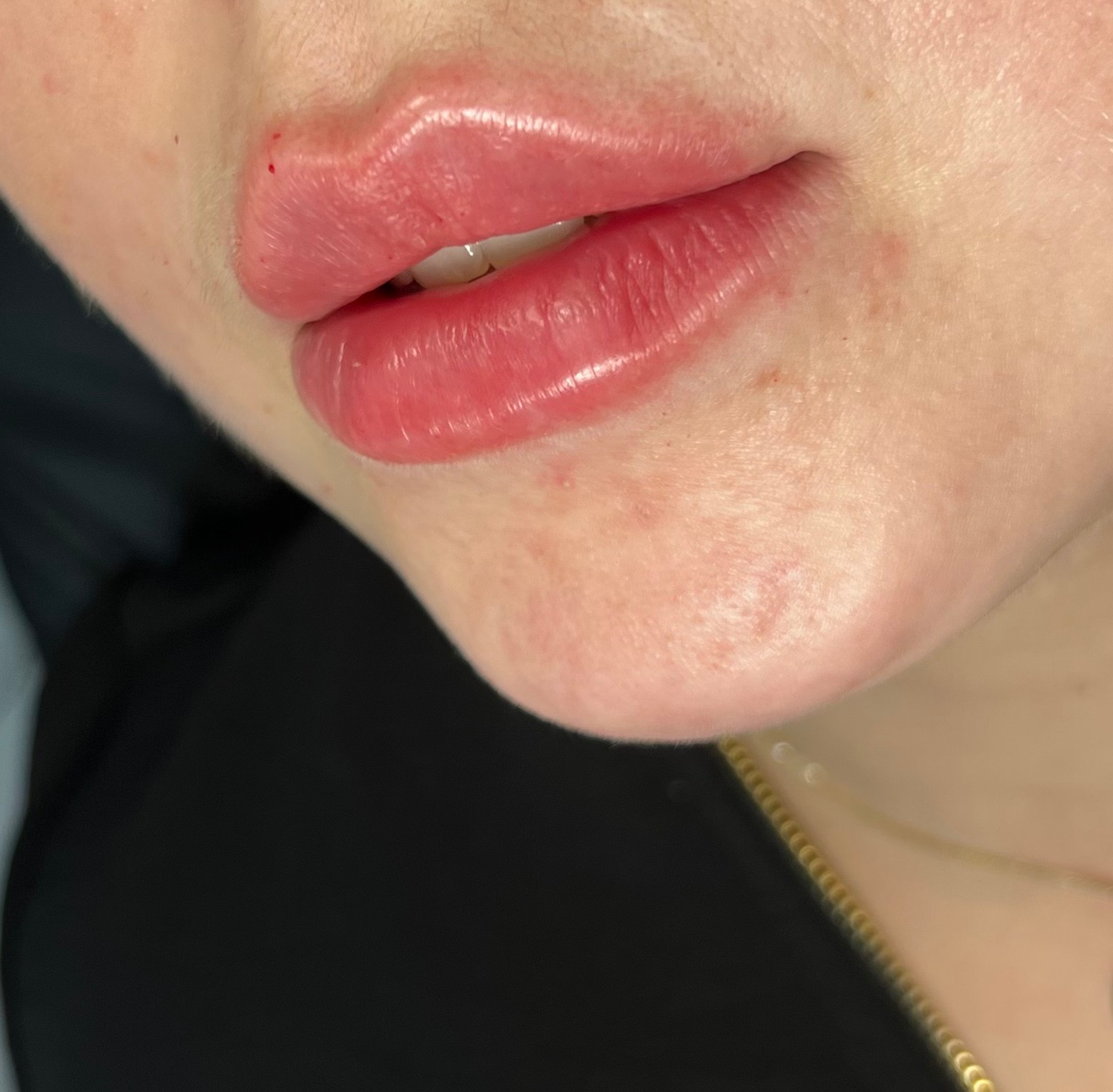 Zbliżenie na usta po zabiegu powiększania, widoczne delikatne zaczerwienienia i błyszczący efekt.