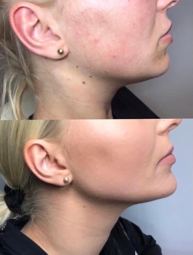 Zdjęcie 'przed i po' przedstawiające efekt zabiegu kosmetycznego na twarzy kobiety, widoczna poprawa kolorytu i redukcja niedoskonałości skóry, ujęcie z profilu.