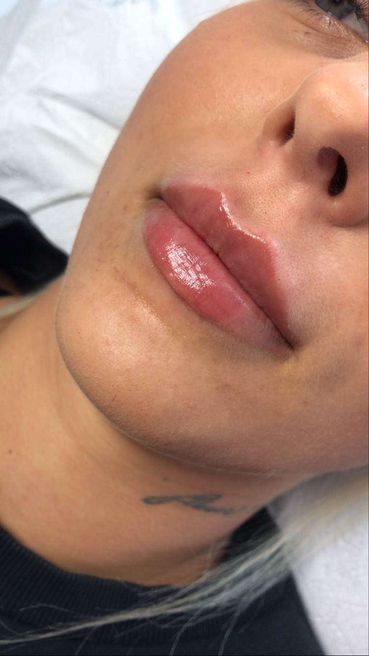 Zbliżenie na kobiece usta tuż po zabiegu powiększania, widoczny połysk i lekkie zaczerwienienie skóry wokół ust, delikatny tatuaż na szyi.