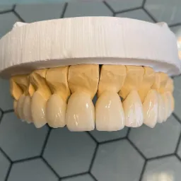 Model szczęki z ceramicznymi licówkami na gipsowym podłożu, widoczne detale struktury powierzchni licówek i ich dopasowanie do podłoża, na tle szarej, heksagonalnej płytki.