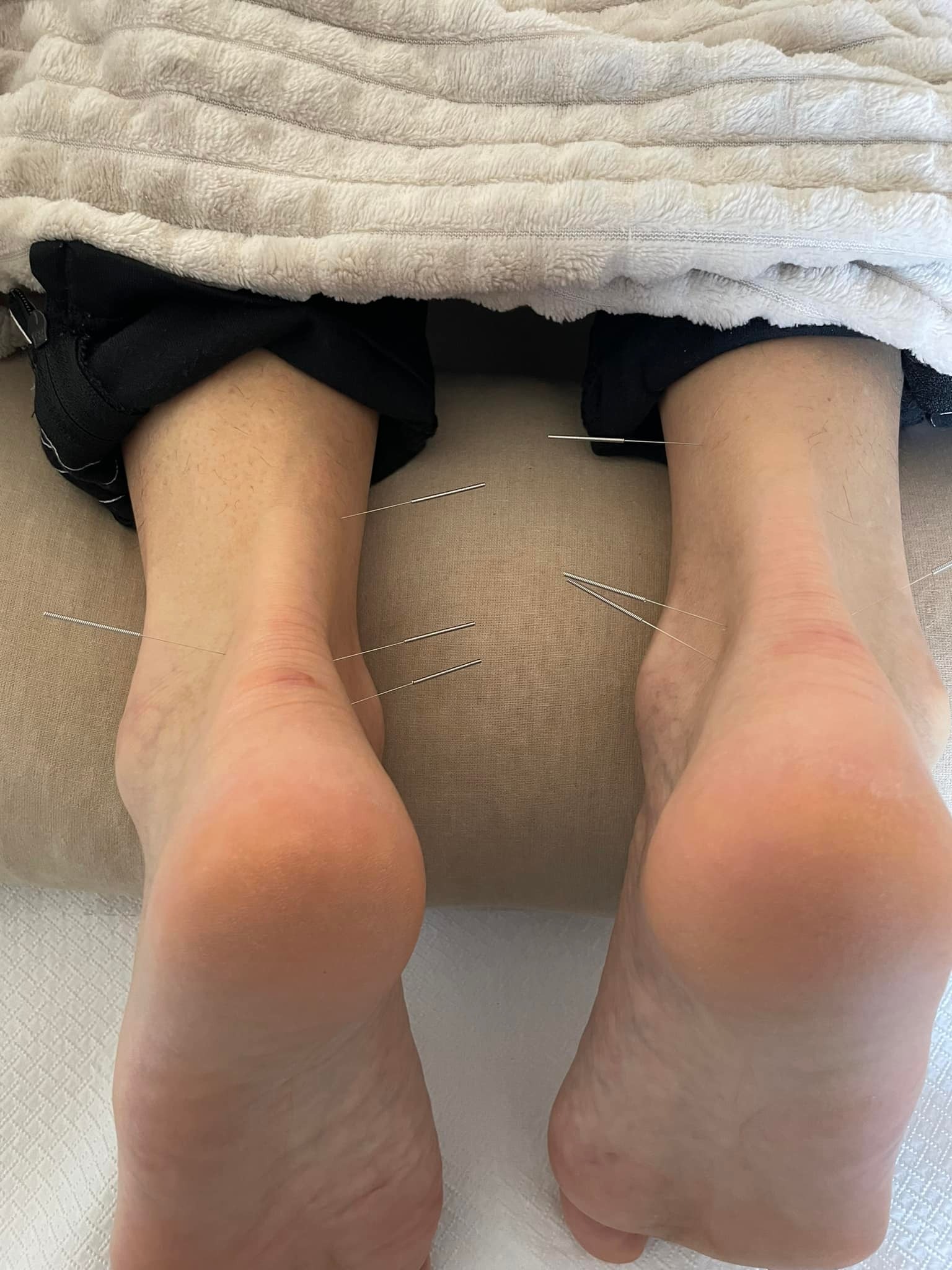 Stopy pacjenta z igłami do akupunktury w okolicy kostek, widok z góry, czarne spodnie dresowe i beżowy koc w tle.