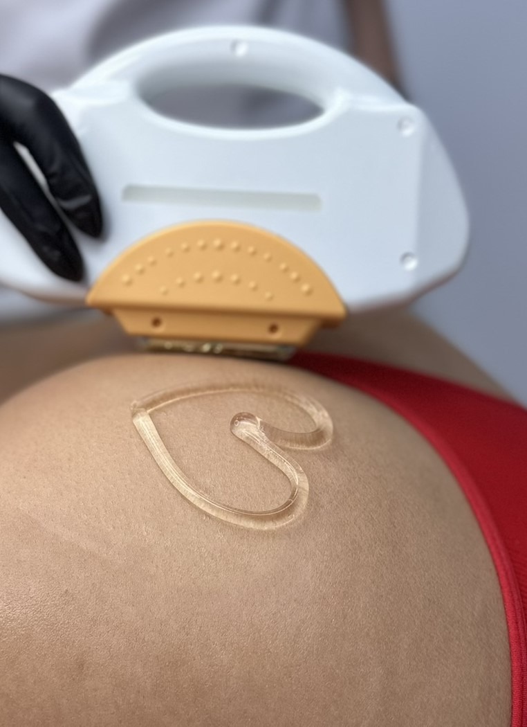 Aplikacja żelu w kształcie serca na skórze pacjenta podczas zabiegu z użyciem białego urządzenia z pomarańczową końcówką, obsługiwanego przez osobę w czarnej rękawiczce.