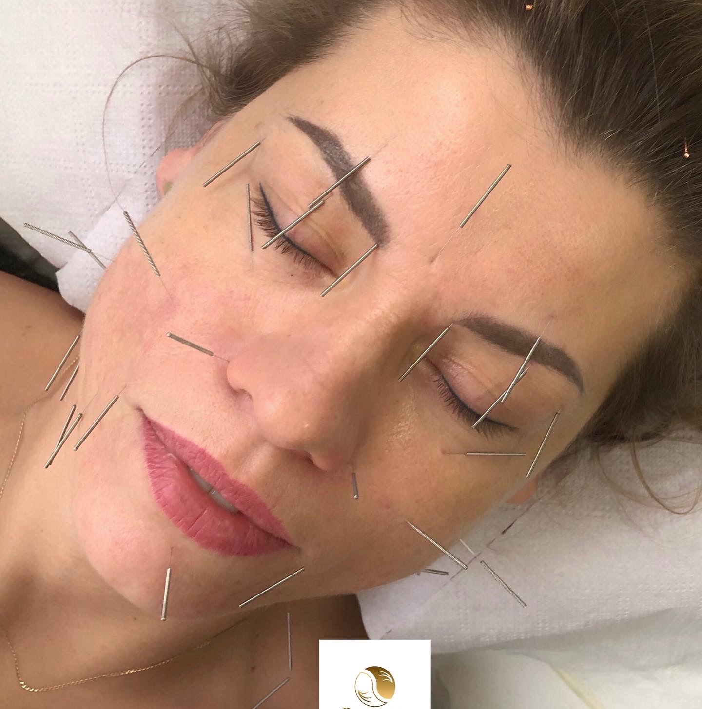 Kobieta z zamkniętymi oczami poddawana zabiegowi nakłuwania igłami na twarzy w Chrzanowie. Widoczne liczne cienkie igły w różnych punktach twarzy, skupione wokół ust i oczu.