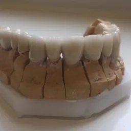 Model gipsowy szczęki z założonymi tymczasowymi koronami z kompozytu, osadzony na białej podstawce. Widoczne niedoskonałości gipsu i różnice w odcieniach kompozytu.