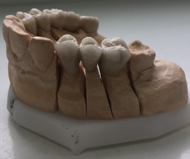 Model gipsowy szczęki z nałożonymi koronami tymczasowymi, widoczne precyzyjne separacje między zębami.