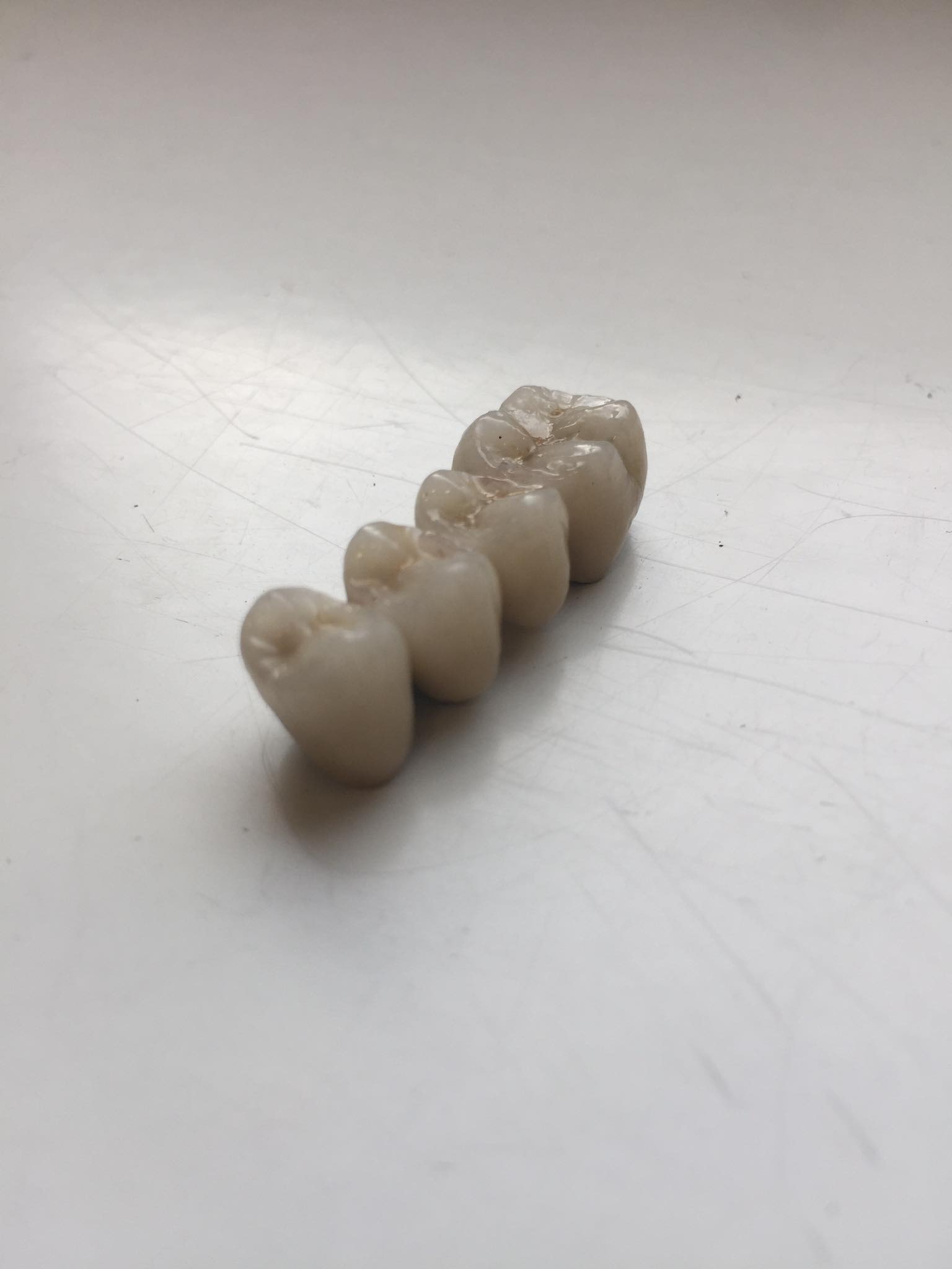 Czteroelementowy most protetyczny z ceramiki na białym tle z widocznymi detalami anatomicznymi