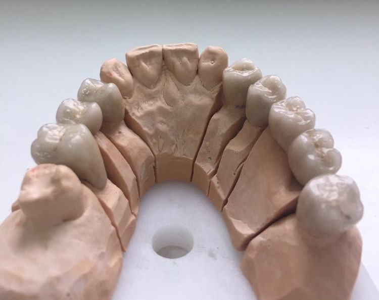 Model gipsowy szczęki z osadzonymi ceramicznymi koronami zębów trzonowych i przedtrzonowych, widoczne niedoskonałości gipsu.