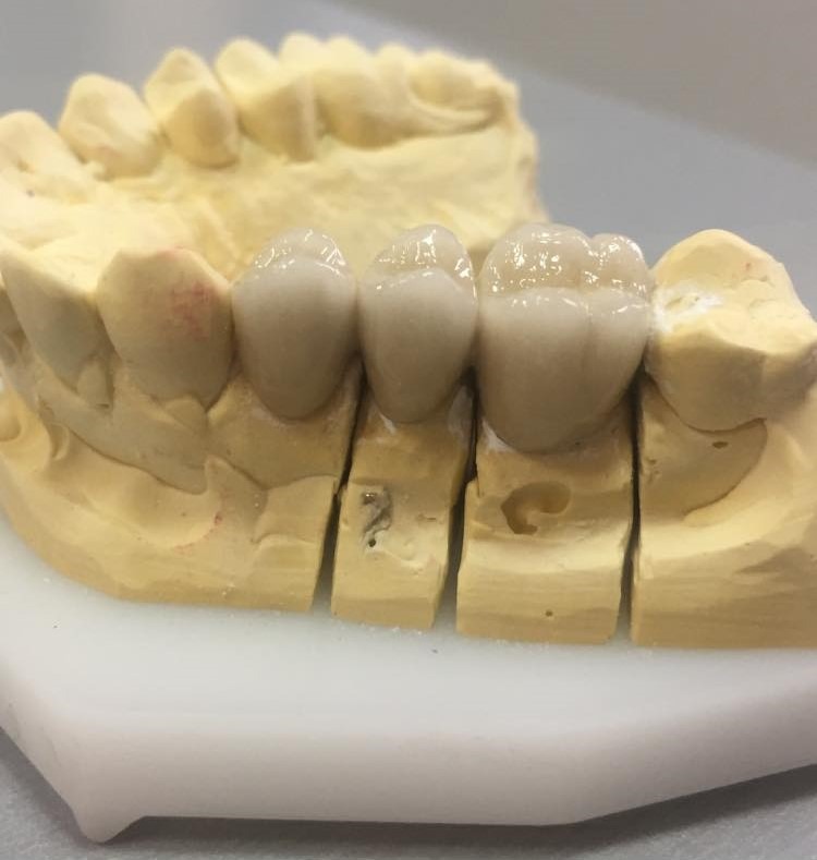 Model gipsowy z trzema ceramicznymi koronami zębowymi, widoczne detale mocowania i wykończenia.