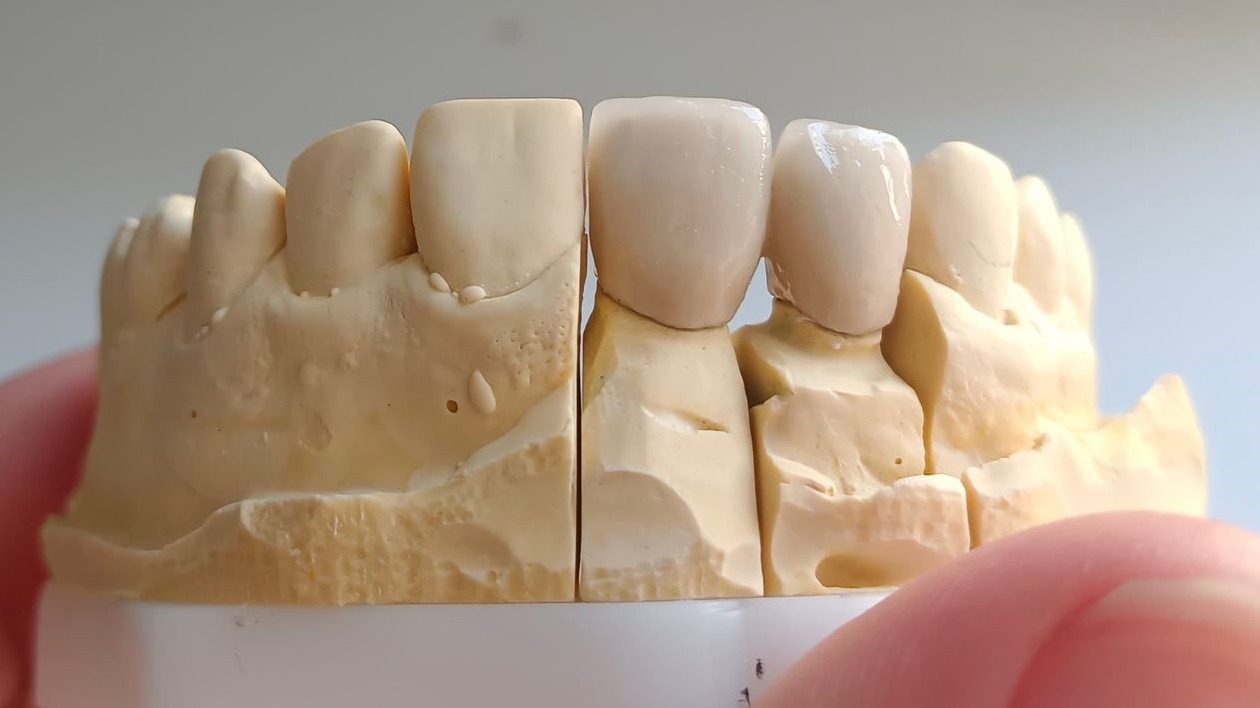 Model gipsowy szczęki z założonymi dwoma ceramicznymi koronami na środkowych zębach, trzymany w dłoni.