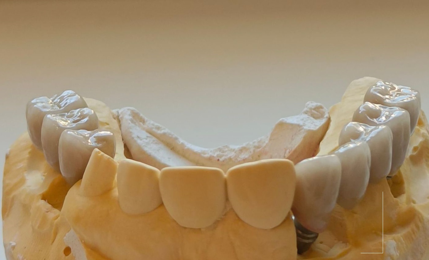 Model gipsowy szczęki z nałożonymi porcelanowymi koronami i mostem, widoczny implant zębowy.