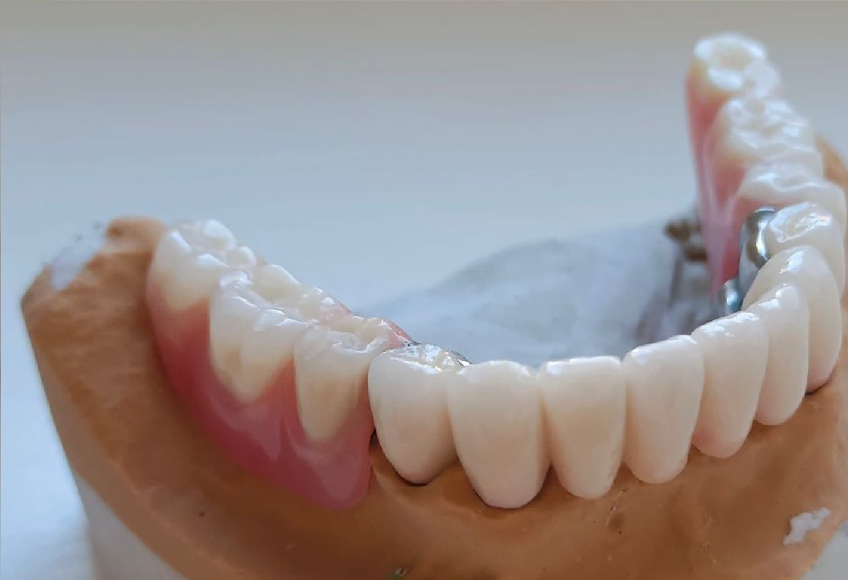 Model górnej szczęki z częściową protezą szkieletową z klamrami, osadzoną na gipsowym podłożu.