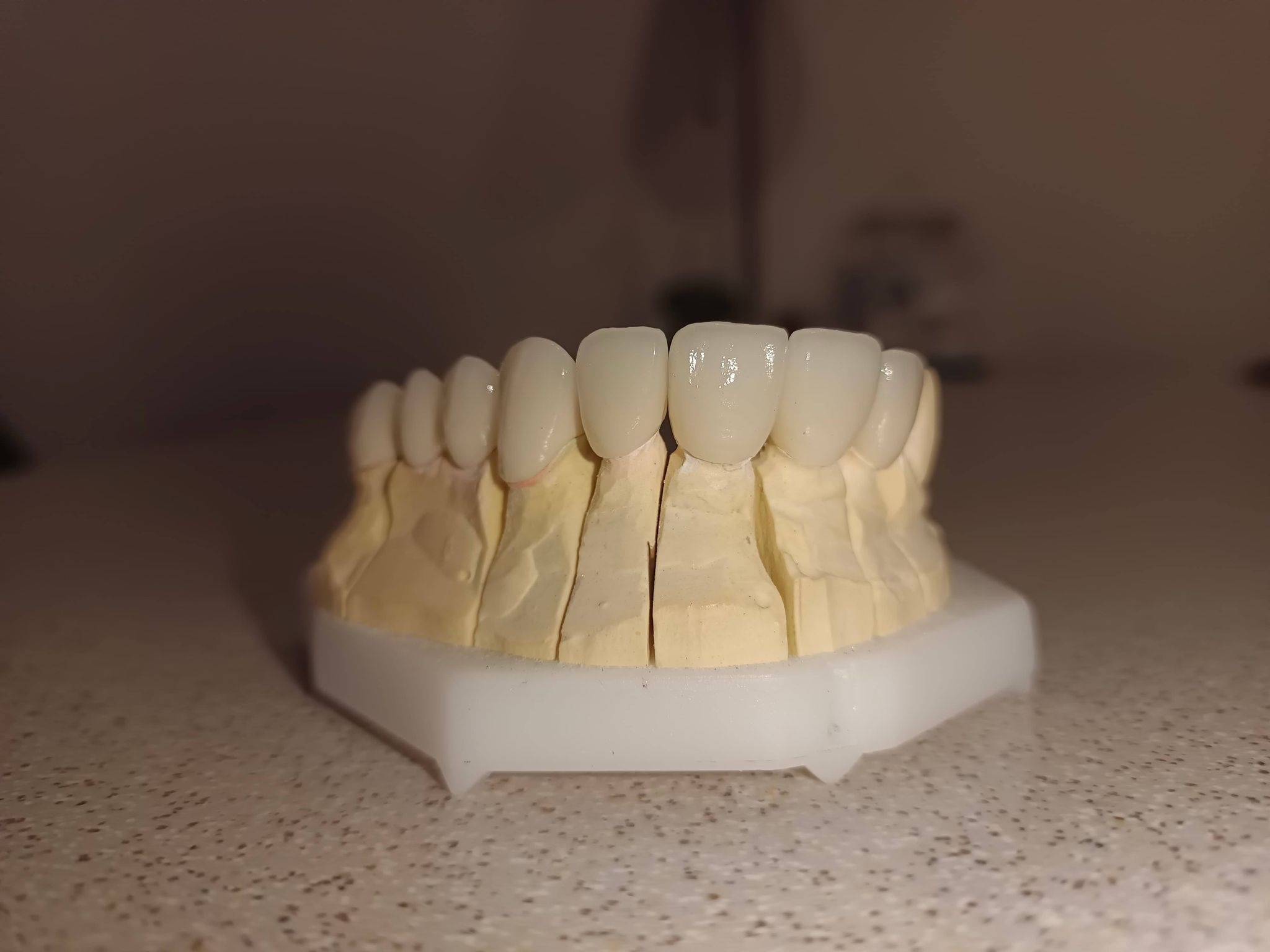 Model gipsowy szczęki z założonymi tymczasowymi koronami akrylowymi, umieszczony na białej podstawie z tworzywa sztucznego, prezentowany w słabym oświetleniu.