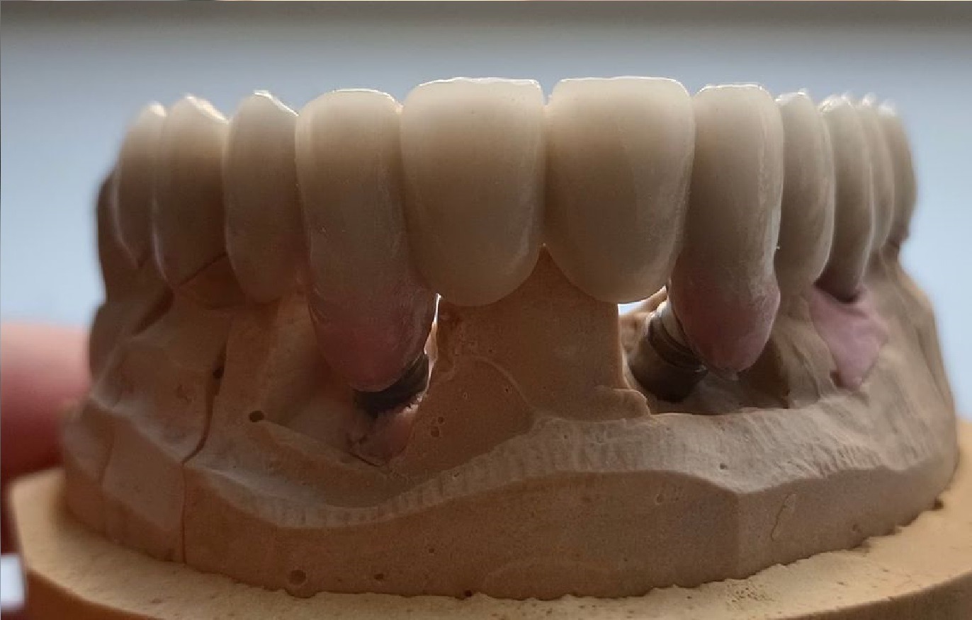 Model gipsowy z zamocowanym mostem protetycznym na implantach, widoczne połączenia implantów, różowe dziąsła protetyczne i korony zębowe.