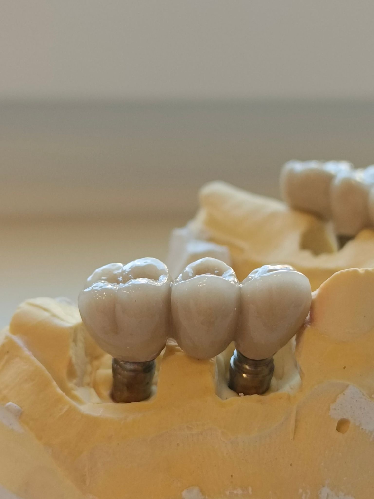 Model gipsowy z trzema zębami tworzącymi most protetyczny, osadzonymi na implantach, w jasnym oświetleniu.