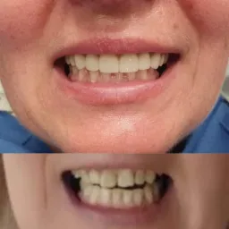 Porównanie uśmiechu przed i po zabiegu: górne zęby po wybielaniu i korekcie, dolne zęby przed zabiegiem, widoczne przebarwienia.