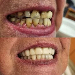 Porównanie stanu uzębienia przed i po zabiegu: górny kadr ukazuje zęby z przebarwieniami i ubytkami, dolny kadr prezentuje pełny, biały uśmiech z nowymi zębami.