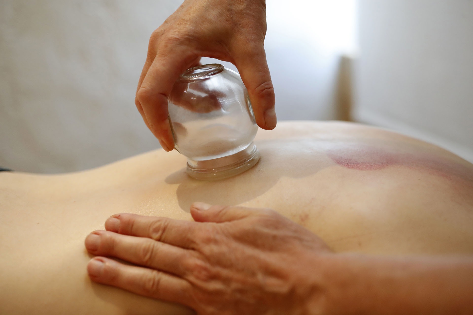 Masaż bańkami: dłoń terapeuty przykłada szklaną bańkę do pleców pacjenta, widoczne zaczerwienienia po wcześniejszych zabiegach.