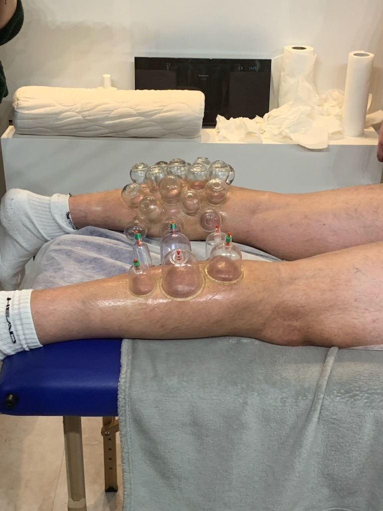 Pacjent leżący na stole z bańkami próżniowymi na nogach, widoczne zaczerwienienia skóry pod bańkami, w tle biała półka z ręcznikami papierowymi i poduszką.