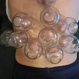 Bańki próżniowe szklane na plecach pacjenta, widoczne zaczerwienienia skóry pod bańkami, fragment ubrania pacjenta