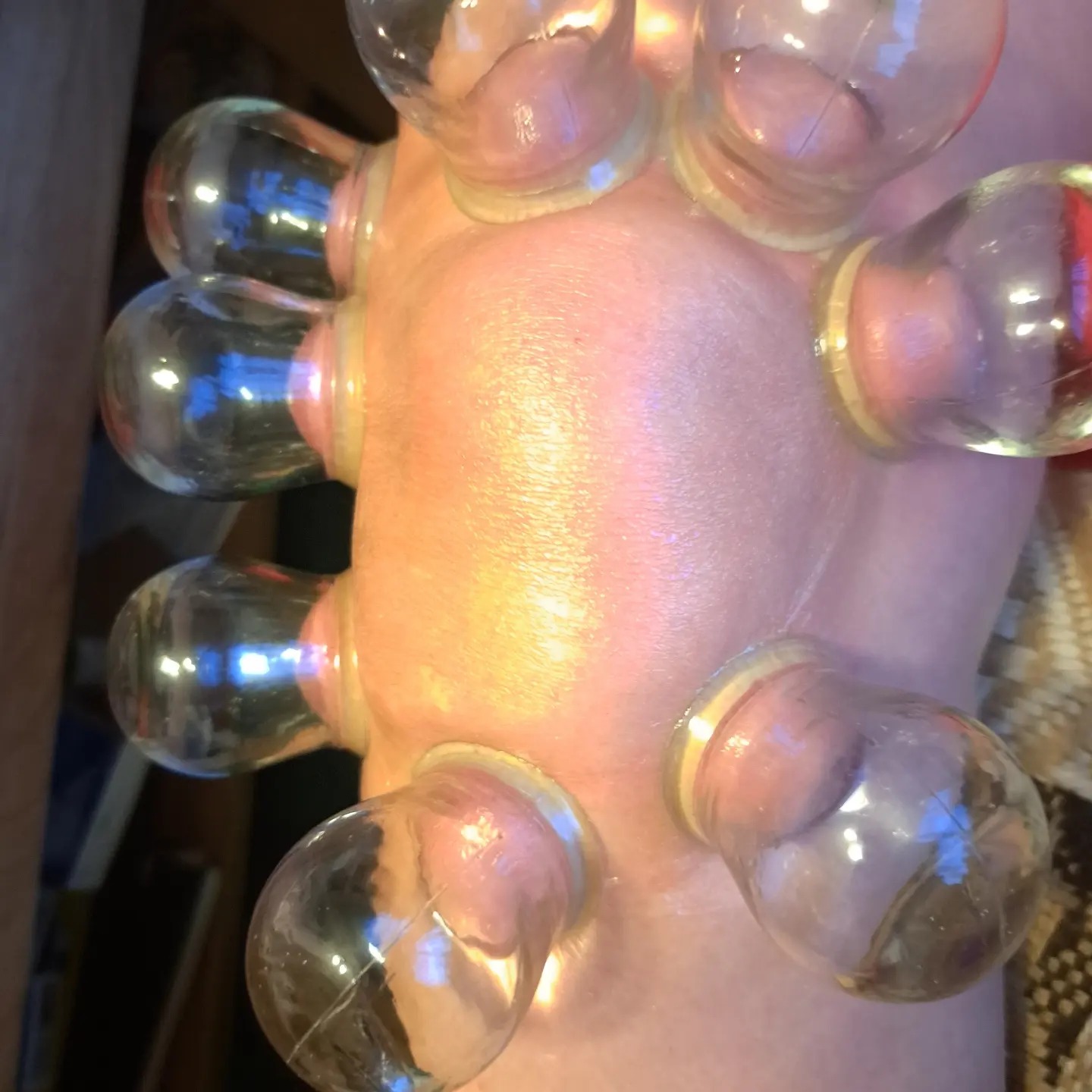 Bliski widok stopy z przyssawkami bańkowymi, widoczne zaczerwienienie skóry pod bańkami, refleksy świetlne na szklanych powierzchniach