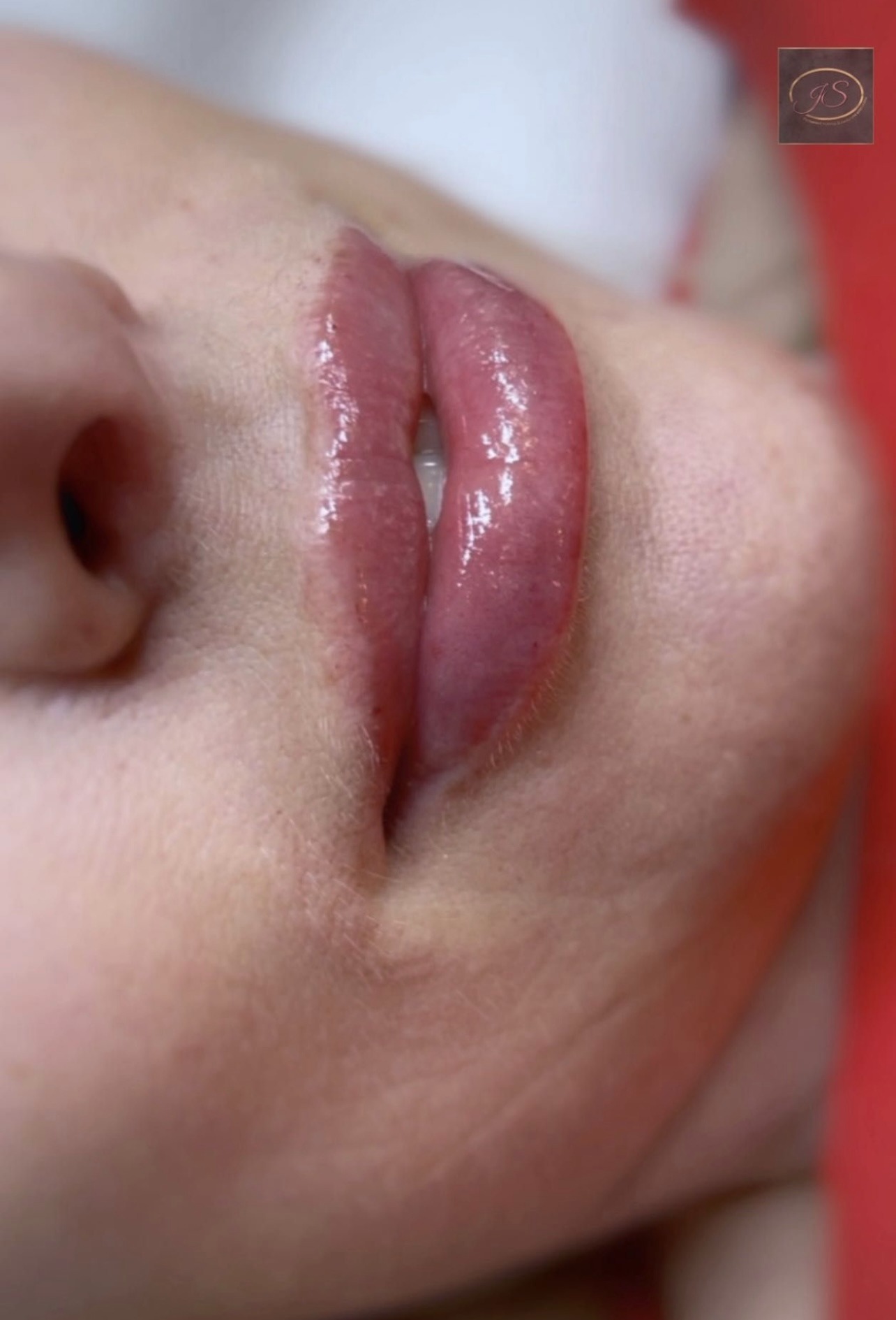 Powiększone usta klientki z Legnicy po zabiegu, widoczne delikatne zaczerwienienie i błyszczący efekt.