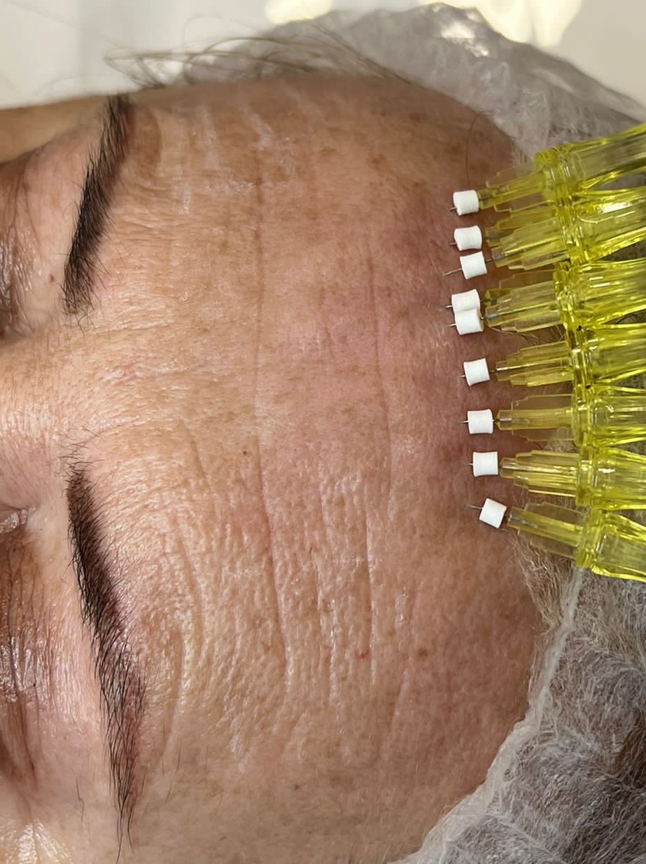 Aplikacja nici liftingujących na czole pacjenta, widoczne żółte uchwyty igieł i białe kołnierze nici.