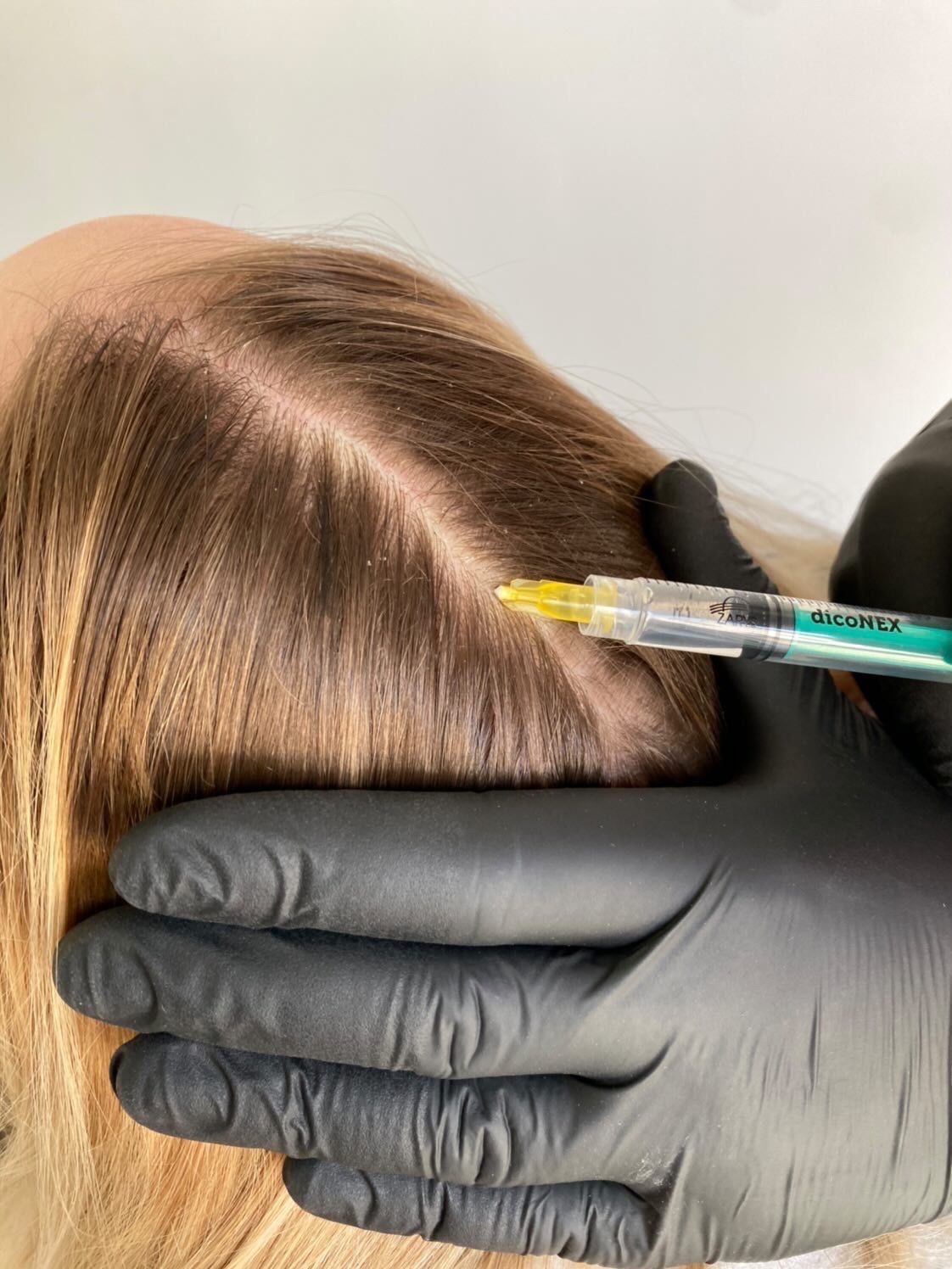 Iniekcja preparatu Diconex w skórę głowy pacjenta z widocznymi włosami blond, wykonywana przez osobę w czarnych rękawiczkach.