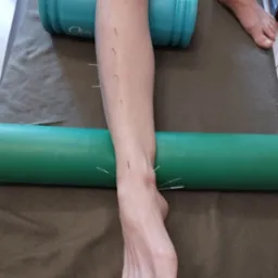 Terapia stawu skokowego oraz zespołu przedniego przedziału powięziowego u zawodowej biegaczki g&oacute;rskiej