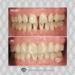 Leczenie protetyczne, licówki porcelanowe.