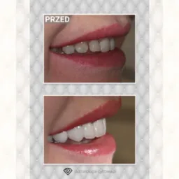 Porównanie stanu zębów przed i po zabiegu: widok z boku na uśmiech, na górze zęby przed, z widocznymi przebarwieniami, na dole zęby po zabiegu, białe i równe.