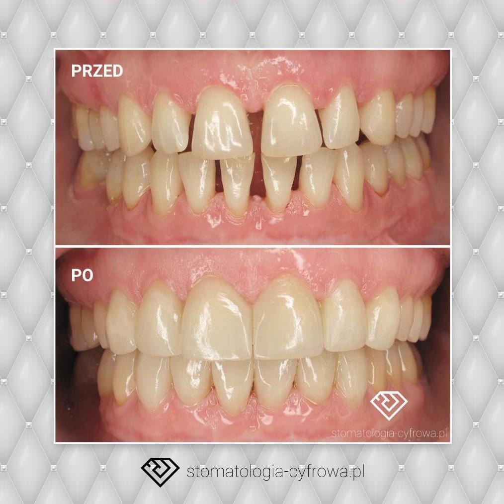 Leczenie protetyczne, licówki porcelanowe.