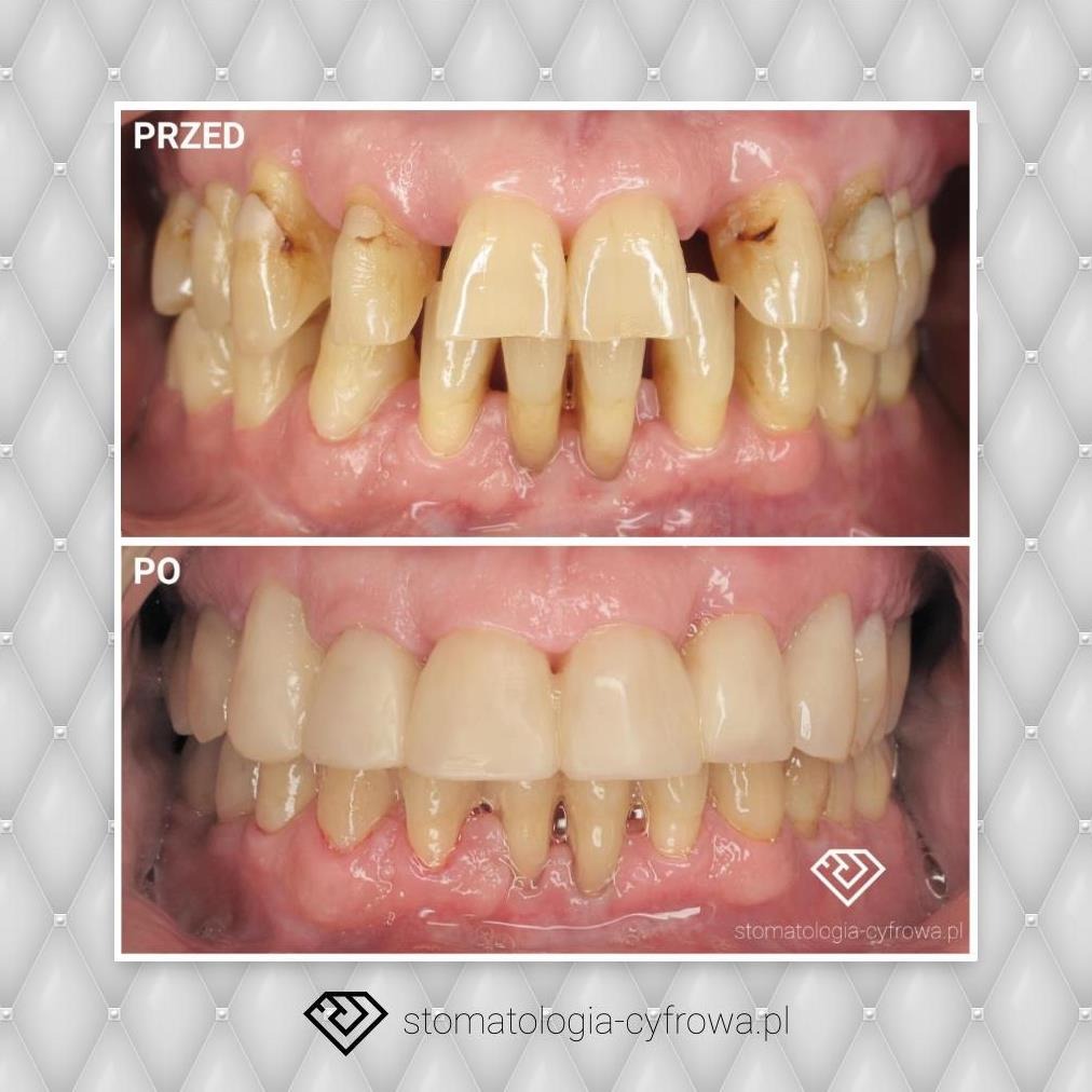 Unieruchomienie zębów, odbudowa kompozytowa.