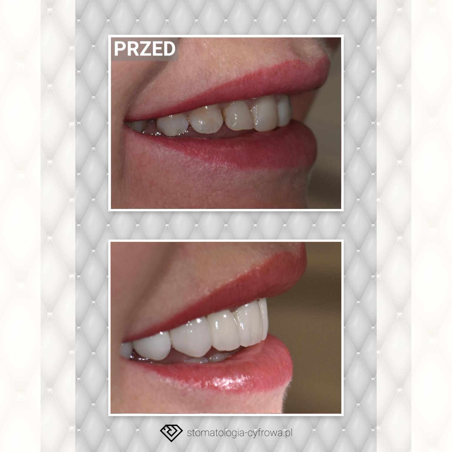Porównanie stanu zębów przed i po zabiegu: widok z boku na uśmiech, na górze zęby przed, z widocznymi przebarwieniami, na dole zęby po zabiegu, białe i równe.