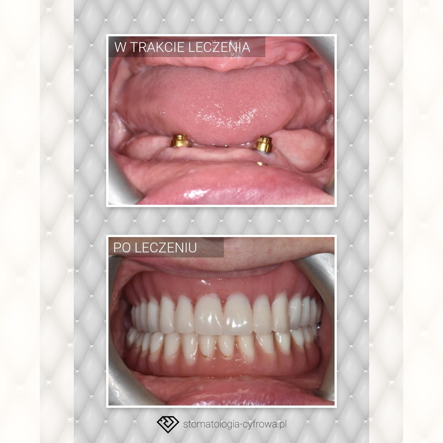 Proteza pełnołukowa na implantach, proteza osiadająca.