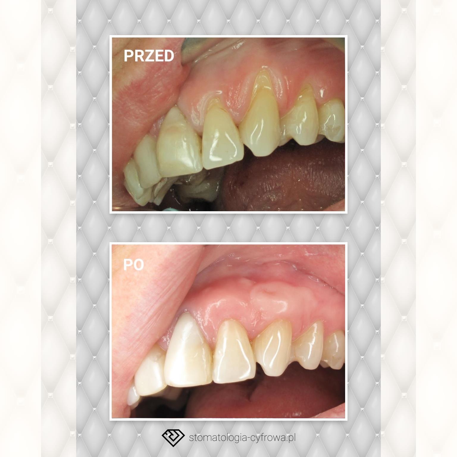 Leczenie recesji dziąsła.