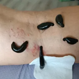 Pijawki medyczne podczas zabiegu na skórze, widoczne ślady po ugryzieniach, na podkładzie z podkładu i wacika.