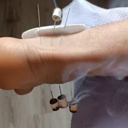 Zabieg akupunktury z moxą na dłoni pacjenta, widoczne igły i dym wydobywający się z palącej się moxy.