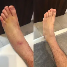 Por&oacute;wnanie stopy i kostki przed i po zabiegu, widoczne zmniejszenie obrzęku i zasinień.
