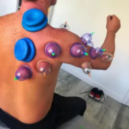 Plecy mężczyzny z bańkami próżniowymi w trakcie zabiegu akupunktury, widoczne ślady po poprzednich zabiegach, w tle para butów sportowych.