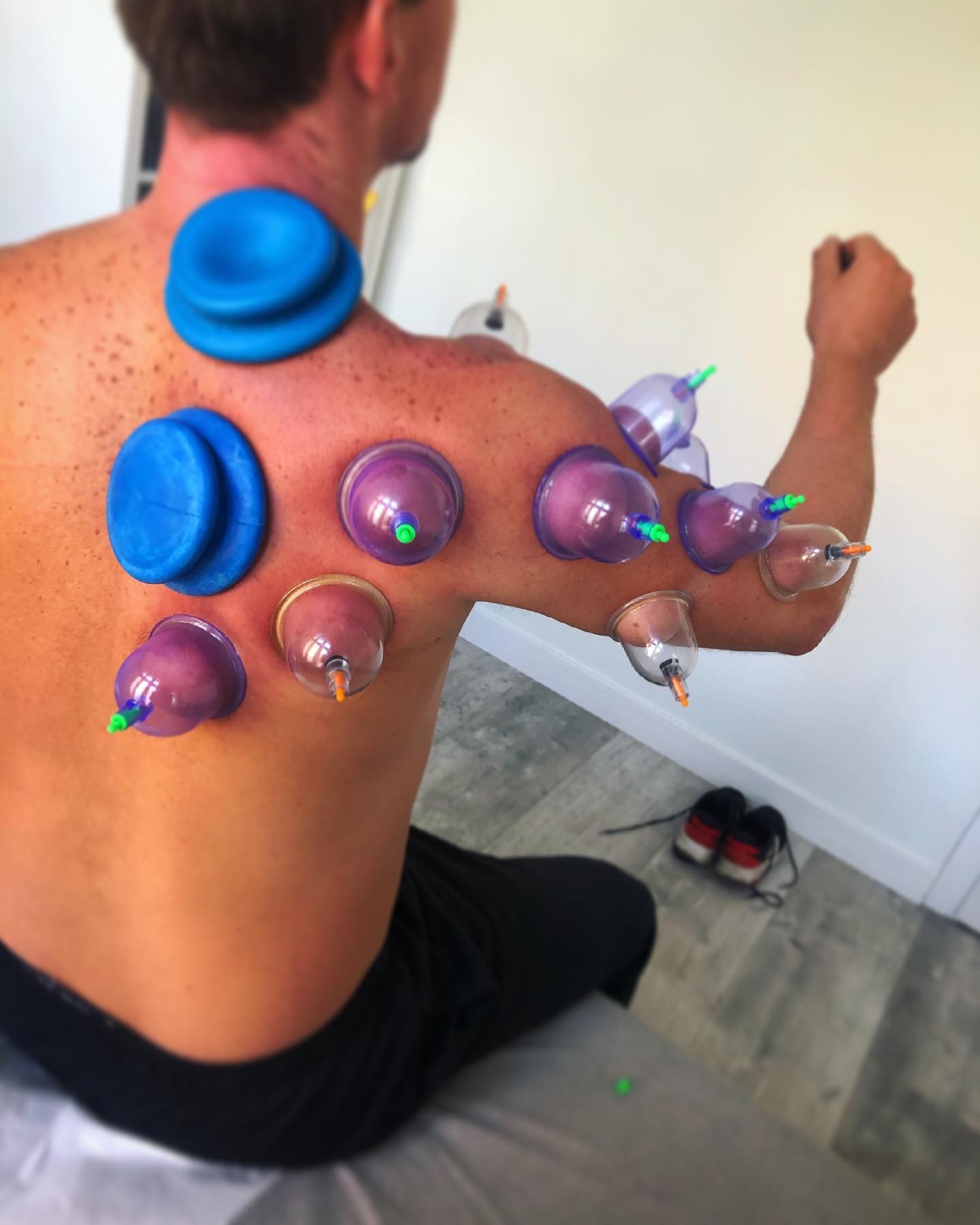 Plecy mężczyzny z bańkami próżniowymi w trakcie zabiegu akupunktury, widoczne ślady po poprzednich zabiegach, w tle para butów sportowych.