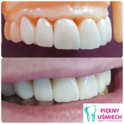Porównanie: model zębów z porcelanowymi licówkami i uśmiech pacjenta po zabiegu, z widocznym logo gabinetu stomatologicznego.