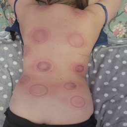 ALEKSANDRA KONOPNICKA - Plecy kobiety po zabiegu bańkami, widoczne okrągłe zaczerwienienia na skórze, leżącej na wzorzystej pościeli.