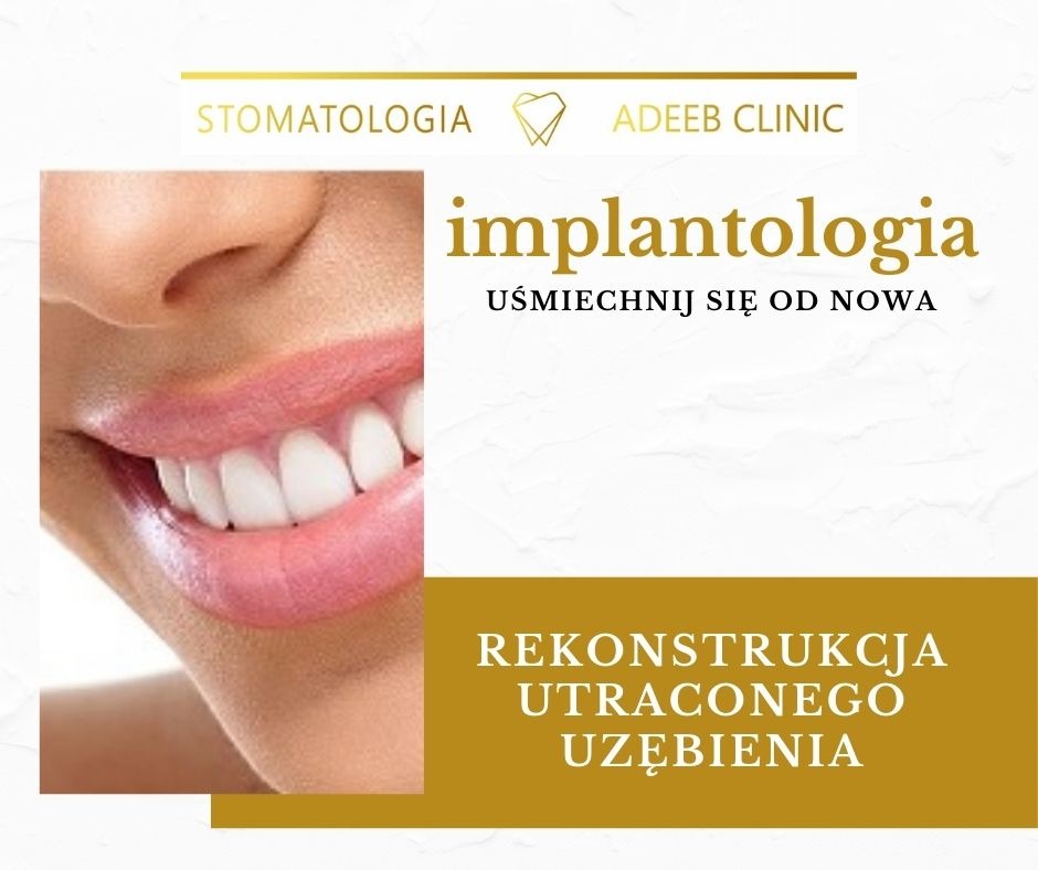Zdjęcie przedstawia uśmiech po zabiegu implantologicznym, z widocznymi białymi zębami i fragmentem twarzy, na tle reklamy z tekstem 'implantologia' i 'rekonstrukcja utraconego uzębienia', logo...