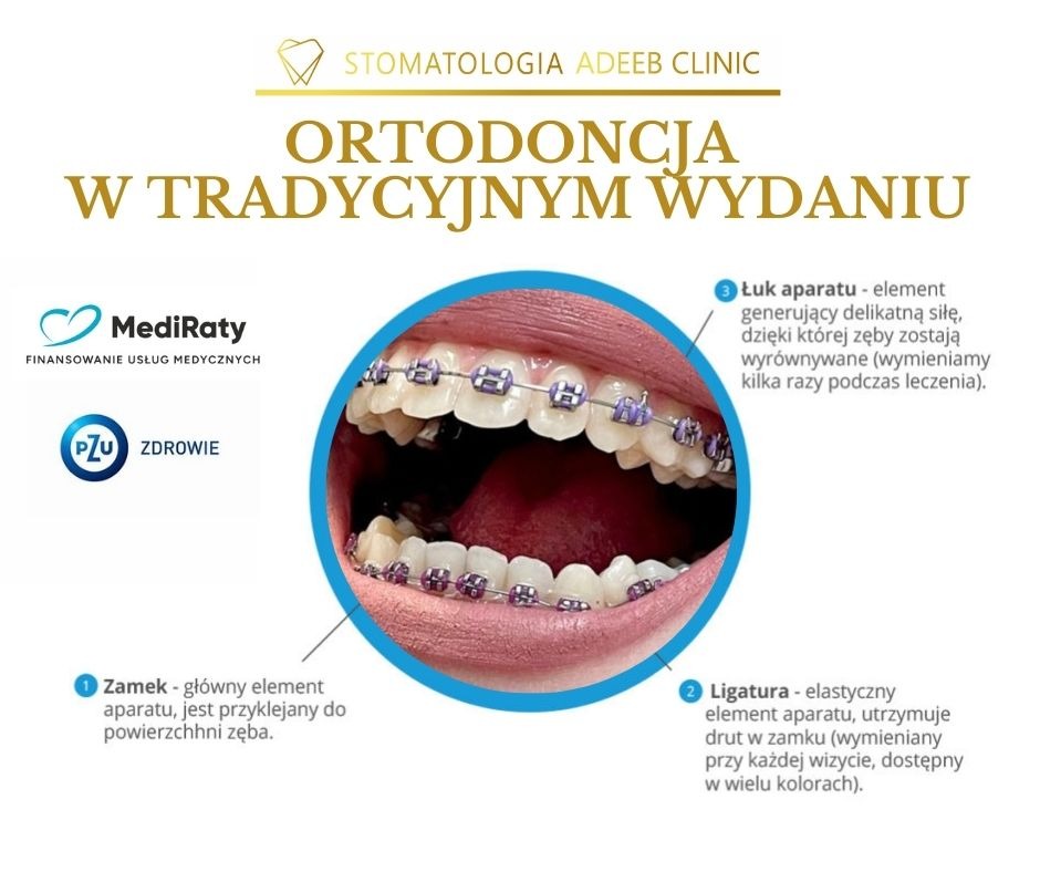 Zbliżenie na zęby z założonym aparatem ortodontycznym z fioletowymi ligaturami, otoczone niebieskim okręgiem z opisami elementów aparatu, na tle logo kliniki stomatologicznej i logotypów MediRaty...
