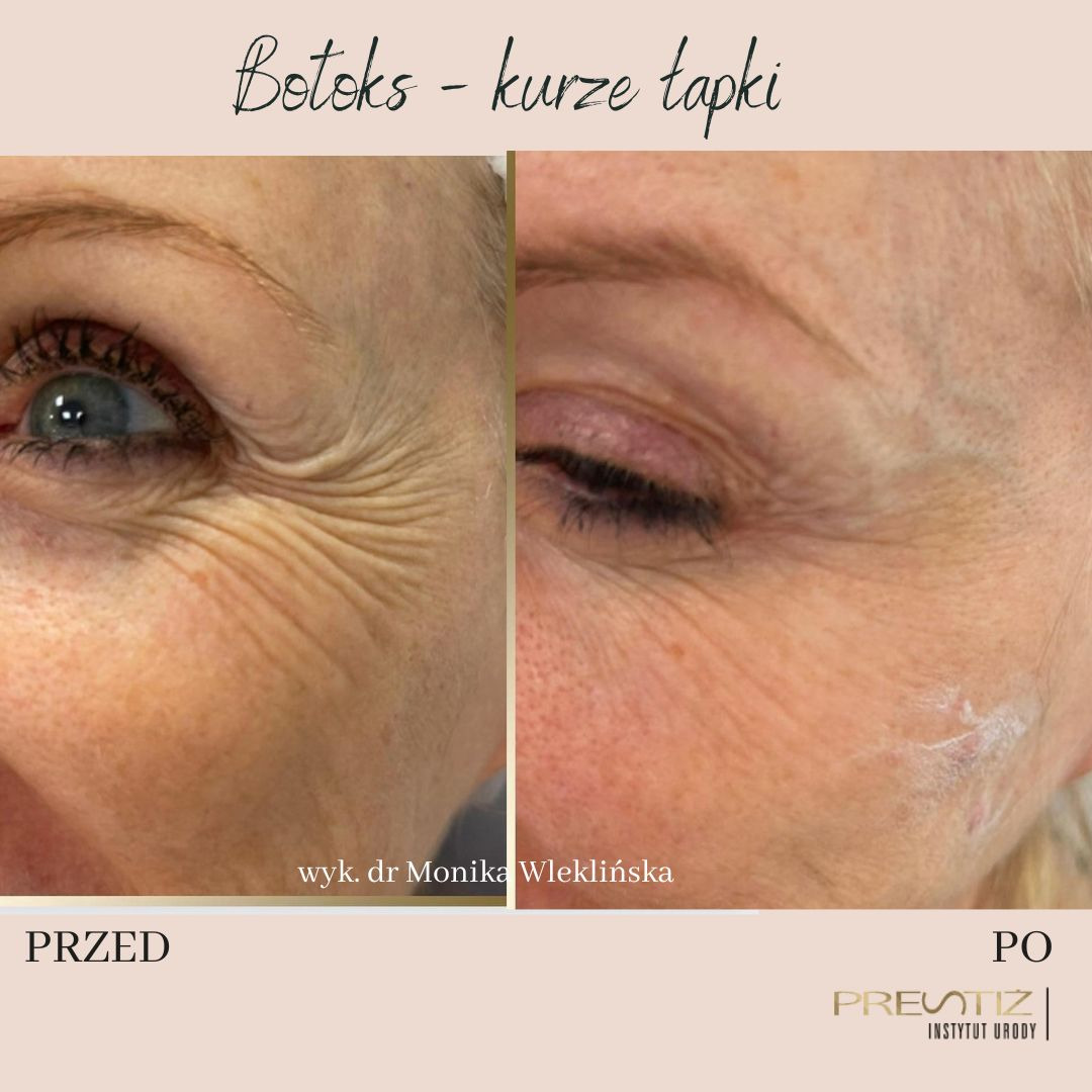 Porównanie skóry wokół oka przed i po zabiegu redukcji zmarszczek, widoczne zmniejszenie 'kurzych łapek' i poprawa napięcia skóry.