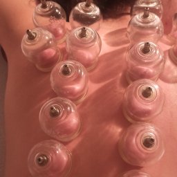 BioSkan Centrum Medycyny Naturalnej - Plecy pacjenta z założonymi szklanymi bańkami do terapii próżniowej. Widoczne zaczerwienienie skóry pod bańkami.