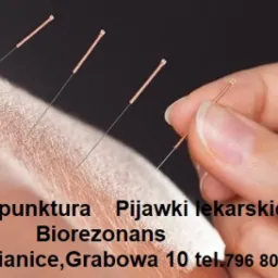 Aplikacja cienkich igieł na skórze dłoni podczas zabiegu akupunktury, zbliżenie na miejsce wkłucia.