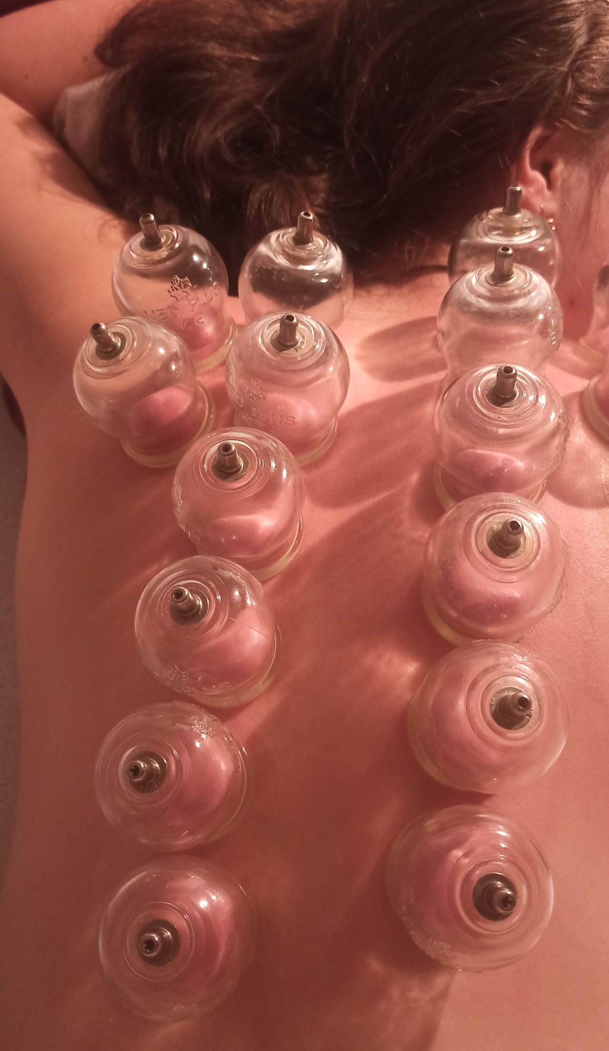 Plecy pacjenta z założonymi szklanymi bańkami do terapii próżniowej. Widoczne zaczerwienienie skóry pod bańkami.