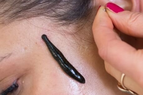 Pijawka lekarska przyczepiona do skroni kobiety, przygotowanie do zabiegu hirudoterapii, widoczne palce z czerwonym lakierem i narzędzie do dezynfekcji skóry.